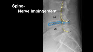 Spine Nerve Impingement [upl. by Atnuahc341]