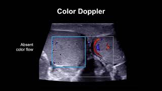 Diagnosing testicular torsion [upl. by Sherrie]