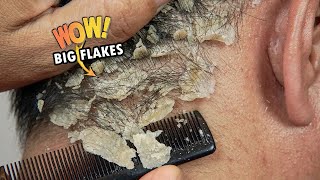 Itchy Psoriasis Scalp Scratching Big Flakes Satisfying 819 [upl. by Gibert]