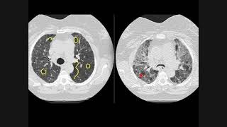 Hypersensitivity pneumonitis how to recognise on chest CT scans [upl. by Jd]