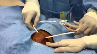 Tunneled Dialysis Catheter Insertion [upl. by Mortie]