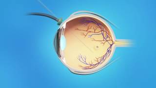 Macular Hole Vitrectomy Surgery [upl. by Arak]