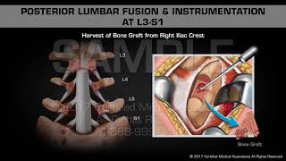 Posterior Lumbar Fusion amp Instrumentation at L3S1 [upl. by Enehs]