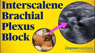 Interscalene Brachial Plexus Block [upl. by Atthia626]