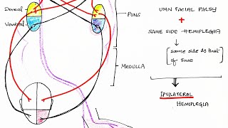 Hemiplegia CVA  Stroke  Theory amp Clinical discussion [upl. by Mapel]