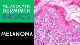 Mole Misdiagnosis When Its Really Stage IV Skin Cancer [upl. by Hatch]