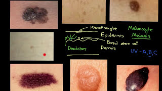 Compound Melanocytic Nevus  Histopathology [upl. by Ahsitruc]