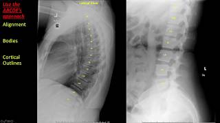 Introduction to Spine Radiographs [upl. by Akener]