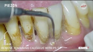 Guided Biofilm Therapy Step 06 Calculus removal with PIEZON® and the PS instrument [upl. by Ridley15]