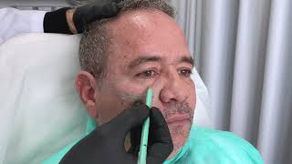 Acido Hialuronico Facial Region Periorbitaria Malar y Tercio Medio por Dr Martin Gaston Alvarez [upl. by Hterrag]