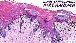 Melanocytic Dermpath Basics Melanoma [upl. by Hildick]