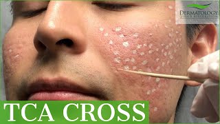 Acne Scar Removal with TCA Cross 80  Los Angeles  Dr Ben Behnam [upl. by Kee655]