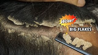 Itchy Scalp Dandruff Removal Satisfying 560 [upl. by Kenimod]