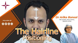 How To Determine The Right Hairline Positioning By Dr Arika Bansal At EugenixHairSciencesofficial [upl. by Agni]