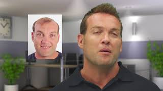 Jacques Kallis hair replacement procedure by Advanced Hair Studio [upl. by Atteloc703]