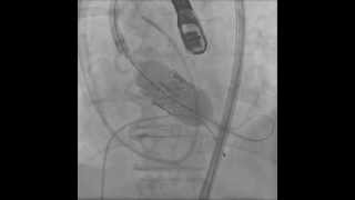 TAVRTrascatheter Aortic Valve ReplacementTransfemoral Deployment [upl. by Ahsoet]