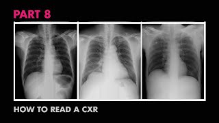 Diaphragms and Pleural Effusion  How to Read a Chest XRay Part 8  MEDZCOOL [upl. by Colligan774]