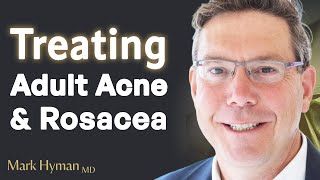 Treating Adult Acne amp Rosacea From The Inside Out [upl. by Halverson]