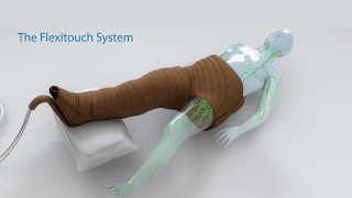 Treating Lymphedema  The Flexitouch System Lymphedema Pump [upl. by Bronk]