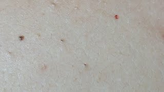 Acne Treatment on the Back Uninfected Lesions [upl. by Jeramey]