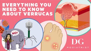 Everything you need to know about verrucas [upl. by Rickard]