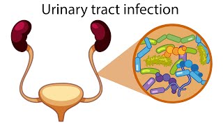 Urinary tract infection web embeddable [upl. by Ynettirb750]