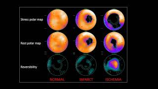 Nucradsharewordpresscom HOW TO READ MYOCARDIAL PERFUSION SCAN [upl. by Ahsetel]