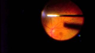 Vitrectomy for Vitreous Opacification FOV [upl. by Noxaj229]