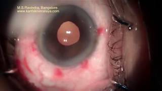 Iris claw IOL implantation [upl. by Etireugram]