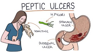 Understanding Stomach and Duodenal Ulcers [upl. by Ricki783]