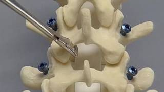 Posterior Lumbar Interbody Fusion PLIF spine surgery [upl. by Cave]