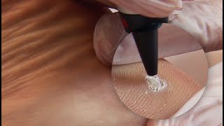 Plantar Wart Treatment [upl. by Templia]