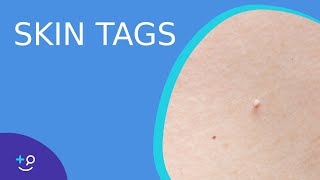 Skin Tags  What they are and how to treat them [upl. by Sucul782]