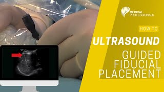 Ultrasound Guided Fiducial Placement for Stereotactic Radiotherapy [upl. by Kaufmann161]