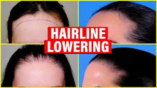 Hairline Lowering Hair Transplant vs Surgical Hairline Advancement [upl. by Niven353]