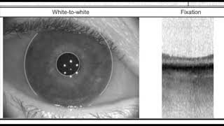 Biometry basics with the IOL master 700 [upl. by Ainalem]