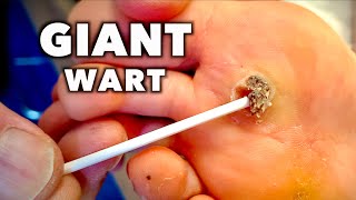 SCRAPING OFF A GIANT DEAD WART  Dr Paul [upl. by Brocky]