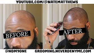 How To Get Your Hairline Back  From Bald To Edge Up  Hairline Restoration [upl. by Ehlke913]