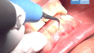 Use of piezo tip PE41PS [upl. by Areval180]