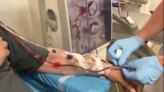 Dialysis connection of a patient with an arteriovenous fistula [upl. by Atteynek]