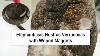 Elephantiasis Nostras Verrucosas and Wound Maggots [upl. by Babby]