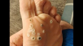 Plantar Wart Removal How to Remove Plantar Warts [upl. by Guido]