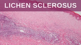 Lichen Sclerosus  Pathology mini tutorial [upl. by Shayn66]