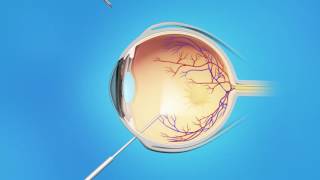 Macular Pucker Vitrectomy Surgery [upl. by Neerak]