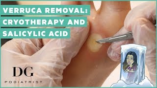 Verruca removal cryotherapy and salicylic acid [upl. by Mandle]