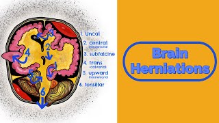 Brain Herniations and Raised ICP [upl. by Niels]