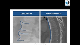 Lumbar Spine MRI Part 6 Phytes and Modic Changes [upl. by Kirsteni956]