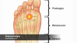 Metatarsalgia Foot Pain Causes Symptoms amp Treatments [upl. by Fedak]