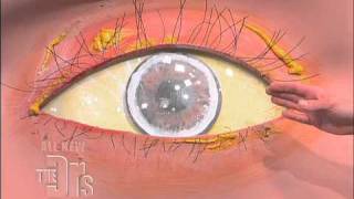 Cholesterol Deposits in the Eye The Doctors [upl. by Rosel]