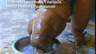 Elephantiasis Afflicts 120 Million in Africa Asia [upl. by Emalee]